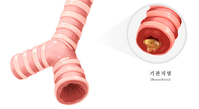 우리몸의 기관지를 표현한 일러스트